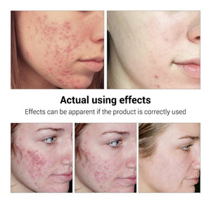 Skin Care Whitening Repair Pimple Remover For Acne