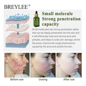Skin Care Whitening Repair Pimple Remover For Acne