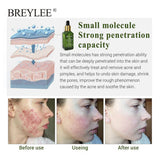 Skin Care Whitening Repair Pimple Remover For Acne