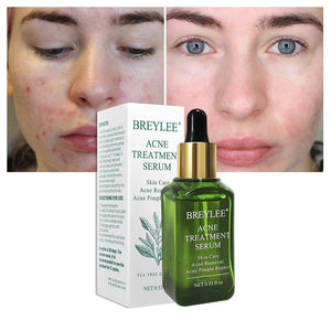 Skin Care Whitening Repair Pimple Remover For Acne
