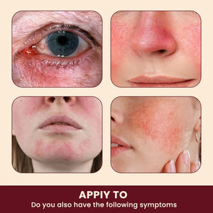 Sumifun - Rosacea Relief Ointment